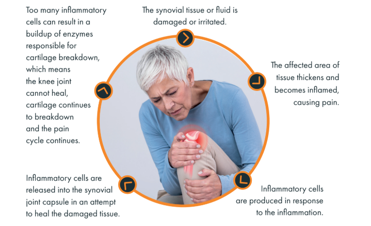 Is Arthrosamid® Right for You