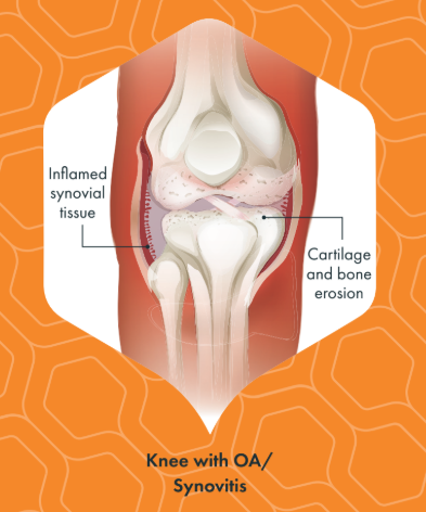 Knee Osteoarthritis