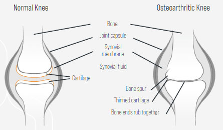 What is osteoarthritis?