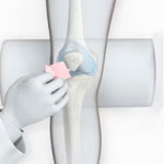 Arthosamid knee injections