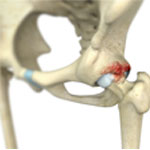 Femoroacetabular Impingement