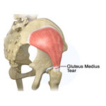 Gluteus Medius Tear