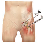 Hip Arthroscopy