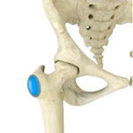 Hip Bursitis