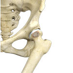 Hip CAM Osteoplasty