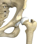 Hip Dislocation