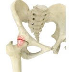 Hip Impingement Surgery