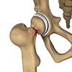 Hip Injury