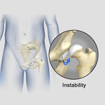 Hip Instability