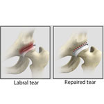 Hip Labral Repair