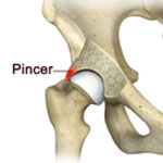 Hip Pincer Takedown