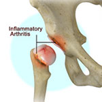 Inflammatory Arthritis of the Hip