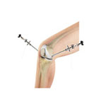 Knee Arthroscopy