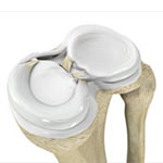 Meniscal Injuries