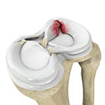 Meniscal Tears