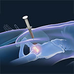 Stem Cell Therapy for Hip Injuries