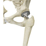 Total Hip Replacement